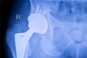 Hip implant x-ray